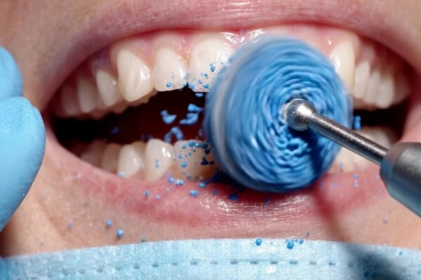 Teeth cleaning and polishing