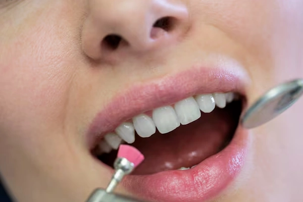 Fluoride treatment