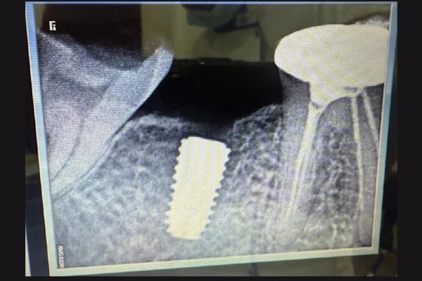 Single tooth implants
