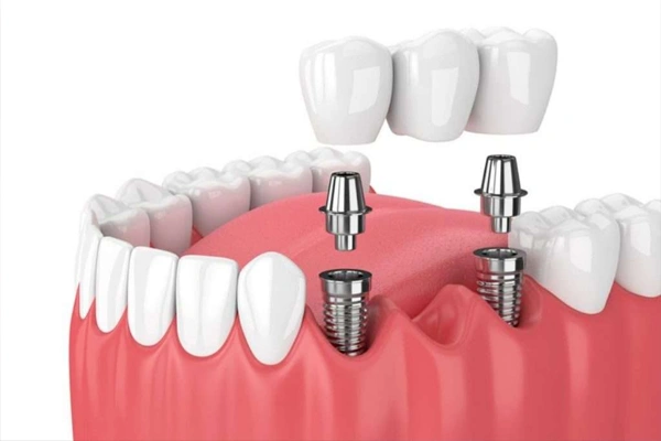 Multiple tooth implants