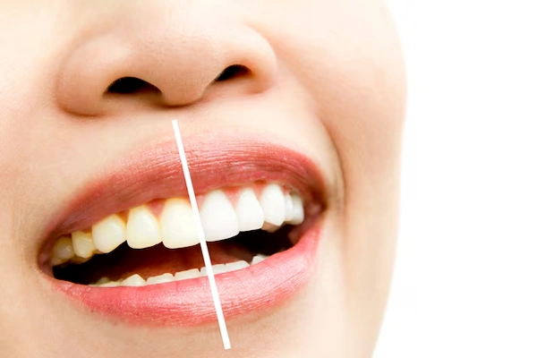 Teeth whitening