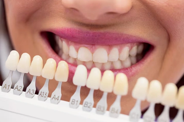 Dental veneers