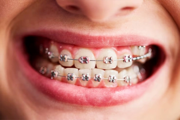 Metal braces