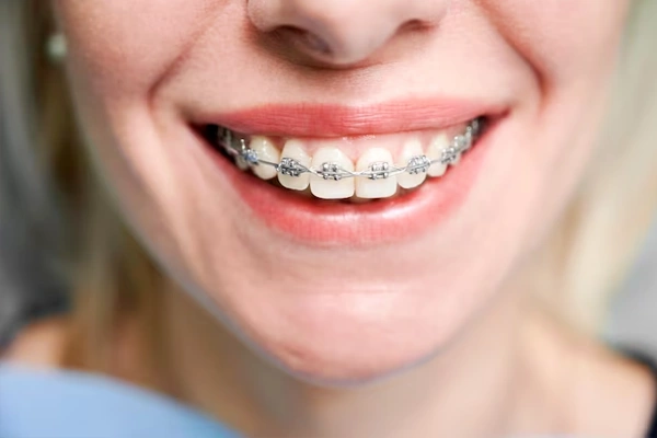 Ceramic braces